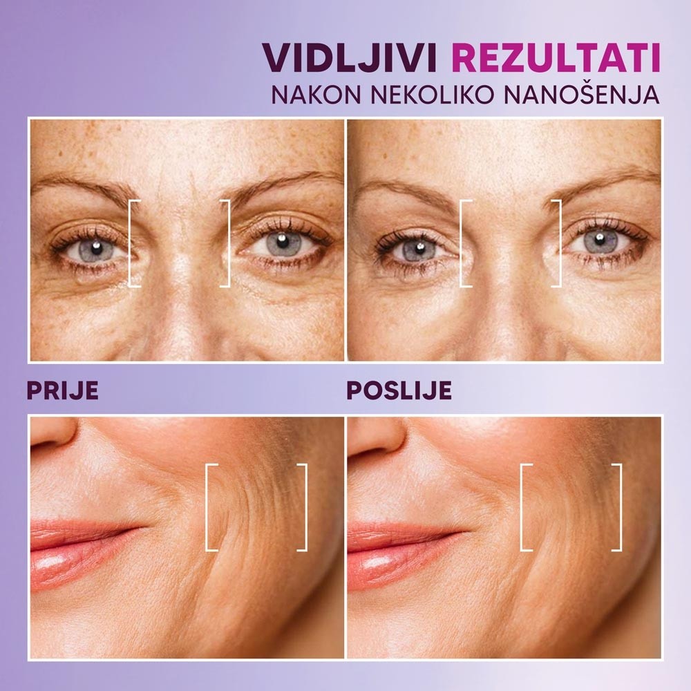 BOTOX---PRIJE-POSLIJE--bih