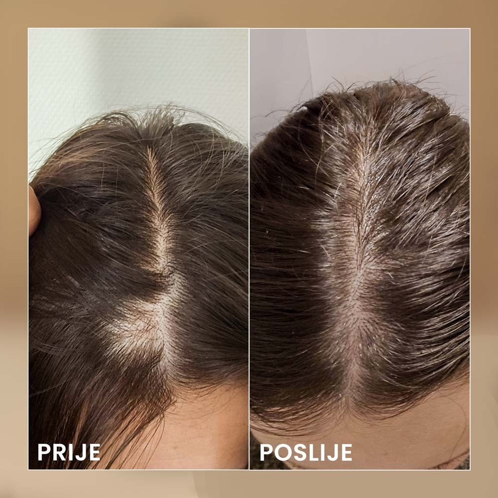 BIOELIXIR-SCALP----prije-posle---BIH